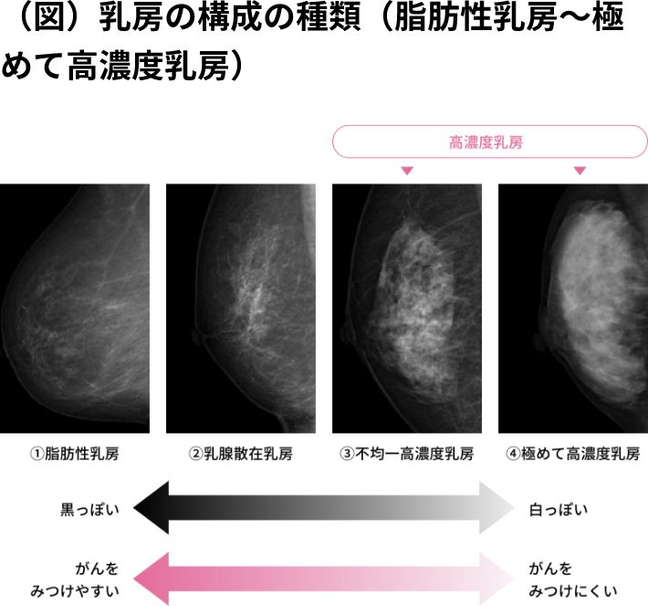 （図）乳房の構成の種類（脂肪性乳房〜極めて高濃度乳房）