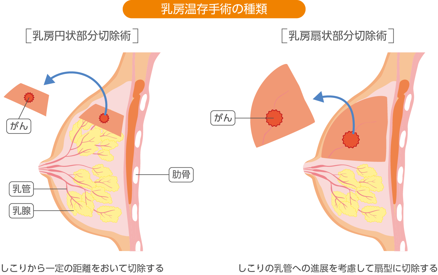 乳房温存手術の種類