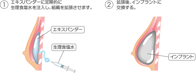 1.エキスパンダーに定期的に生理食塩水を注入し、組織を拡張させます。　2.拡張後、インプラントに交換する。