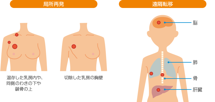 局所再発 遠隔転移