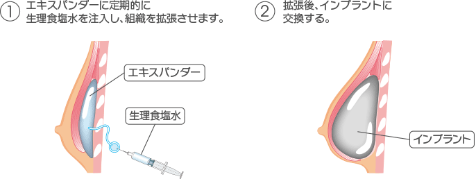 1.エキスパンダーに定期的に生理食塩水を注入し、組織を拡張させます。 2.拡張後、インプラントに交換する。